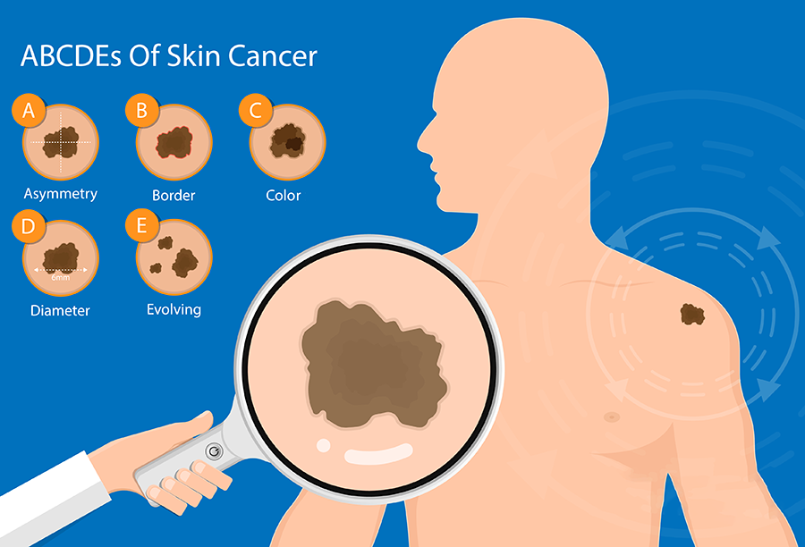 Know the ABCDEs of Skin Changes - Graphic Displaying Skin Lesion Examples of Asymmetry, Border, Color, Diameter, Elevation